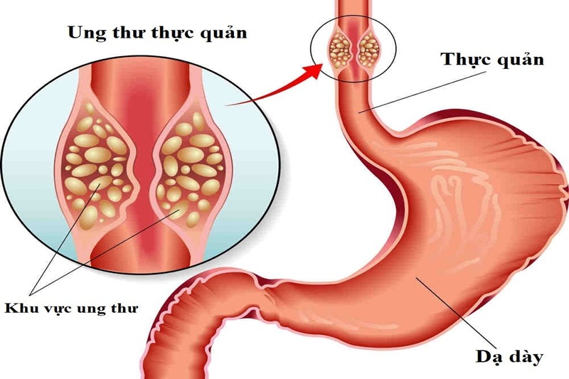 Ung thư thực quản lcó chữa được không một trong những thắc mắc của nhiều người