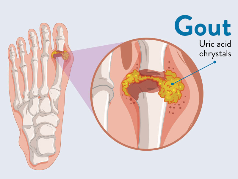 bệnh gout cần được phát hiện và điều trị từ sớm