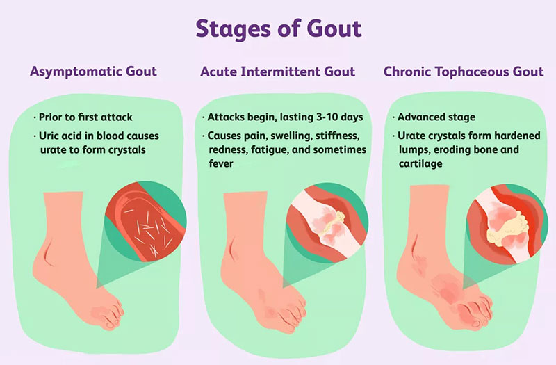 Ở giai đoạn 1, bệnh gút chưa xuất hiện những dấu hiệu của bệnh