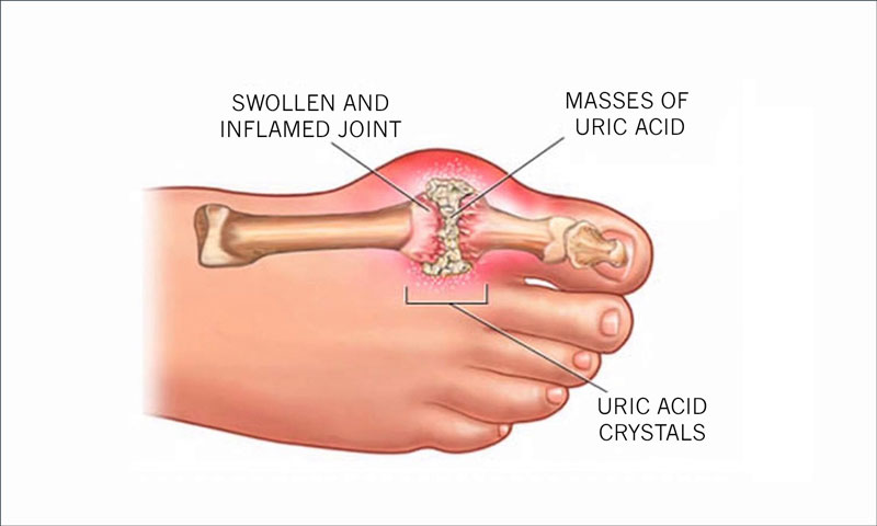 dấu hiệu bệnh dịch gout là dạng viêm khớp sưng đỏ au ở những địa điểm khớp bên trên khung hình khiến cho người bệnh nhức dữ dội