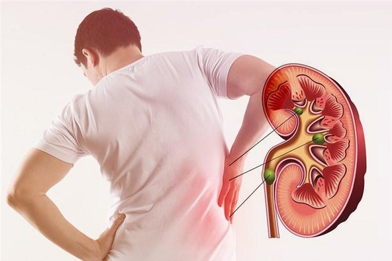 Dư thừa nitơ do dung nạp quá nhiều protein có thể gây suy thận