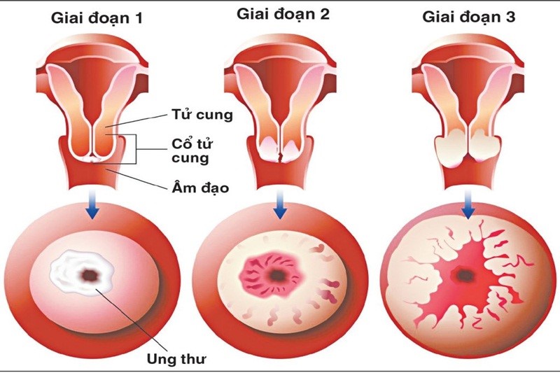 Chủ động thực hiện tầm soát ung thư để phát hiện sớm ung thư cổ tử cung