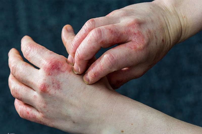 Eczema là bệnh gì? Nguyên nhân, triệu chứng và cách phòng ngừa