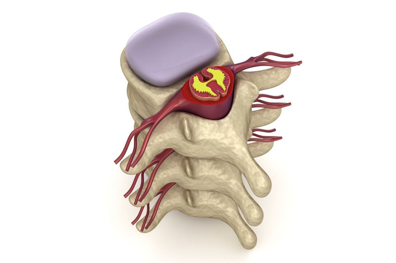 thoát vị đĩa đệm xảy ra nhiều ở người cao tuổi