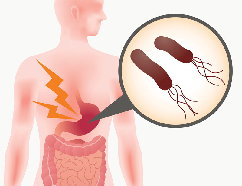 Vi khuẩn HP được xác định là tác nhân chủ yếu gây ra bệnh viêm loét dạ dày