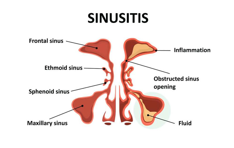 Viêm xoang là tình trạng hốc rỗng trong khối xương sọ có chứa nhiều dịch, mủ khiến niêm mạc bị viêm