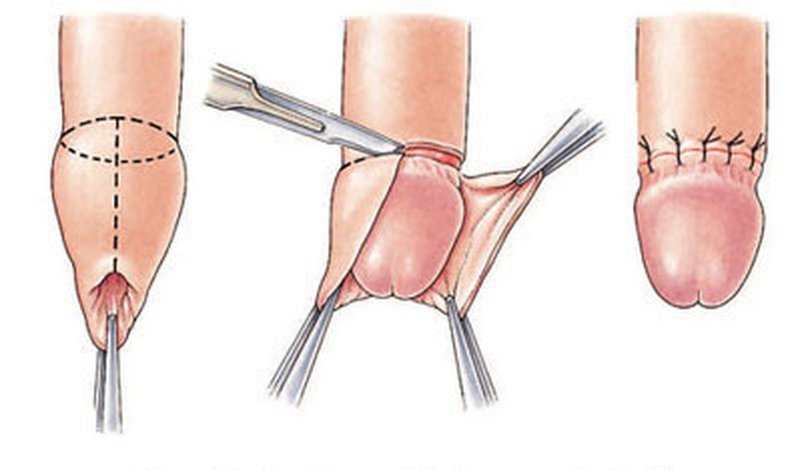  Trường hợp hẹp bao quy đầu điều trị tại nhà không hiệu quả có thể cần can thiệp phẫu thuật