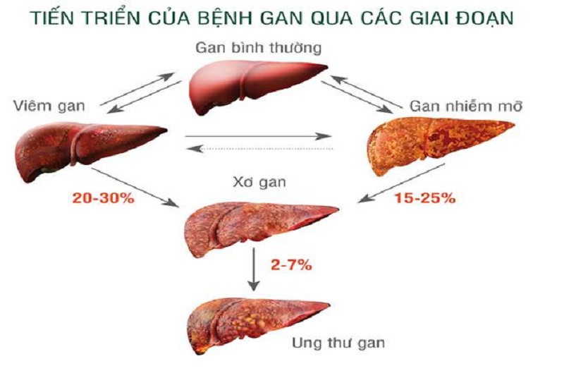 Hình 2: Ung thư gan là một trong những bệnh gây tử vong cao nhất trên thế giới