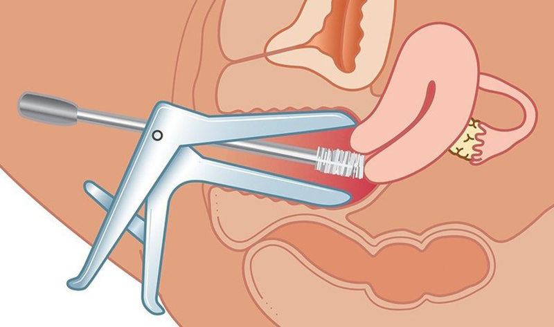 Dụng cụ chuyên dụng trong khám phụ khoa