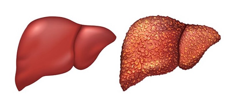 Viêm gan B mạn tính là diễn biến nặng hơn của người nhiễm virus viêm gan B