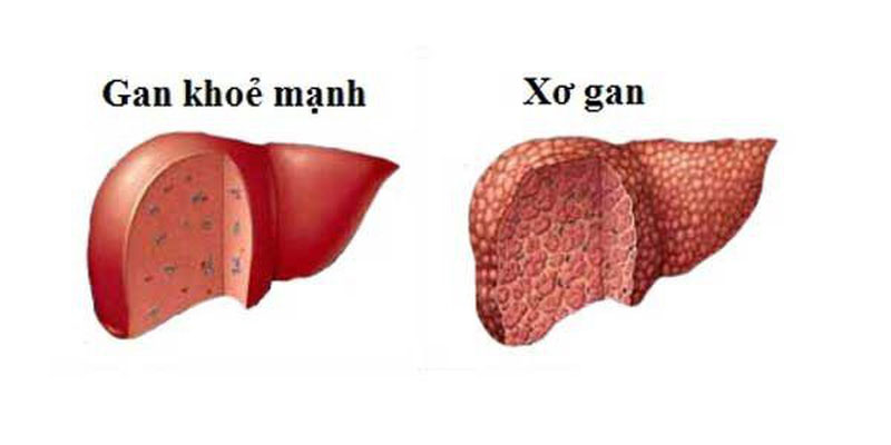 Bệnh nhân bị <a href='https://medlatec.vn/tin-tuc/xo-gan-giai-doan-4-co-dieu-tri-duoc-khong-s62-n17209'  title ='xơ gan'>xơ gan</a> hoặc thiếu máu tán huyết