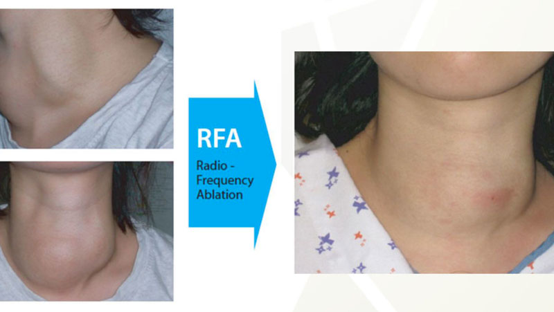 RFA là gì Sau khi đốt sóng cao tần, bệnh nhân sẽ không có vết sẹo xấu xí trên da