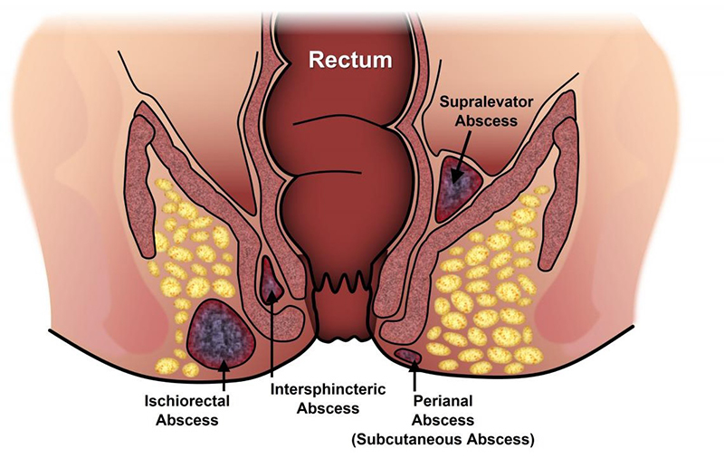 Hình ảnh minh họa các ổ áp xe xung quanh hậu môn
