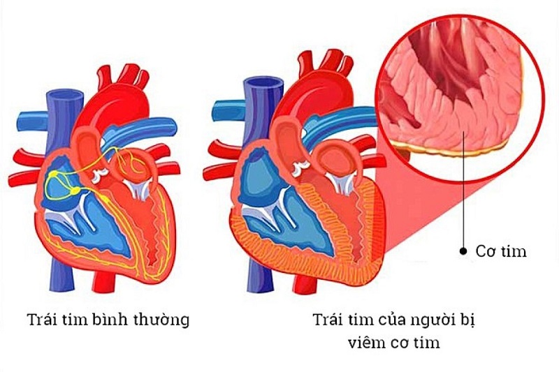 Không nên xem thường mối nguy hiểm từ viêm cơ tim 