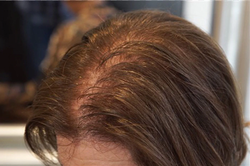 Tại sao tóc rụng nhiều ở người già 