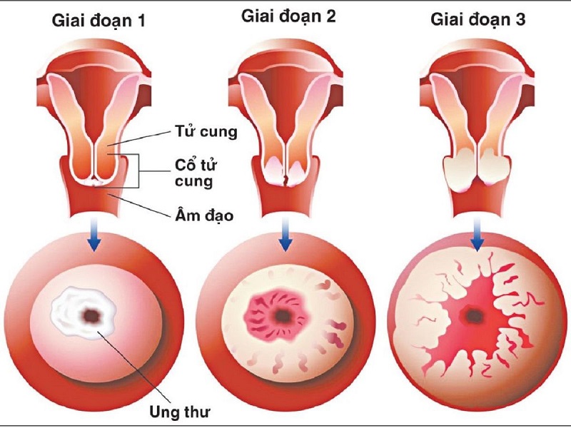 Ung thư cổ tử cung căn bệnh nguy hiểm cần được phát hiện sớm