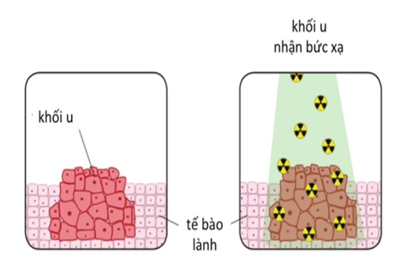 Chữa ung thư bằng xạ trị là phương pháp điều trị khối u bằng tia bức xạ