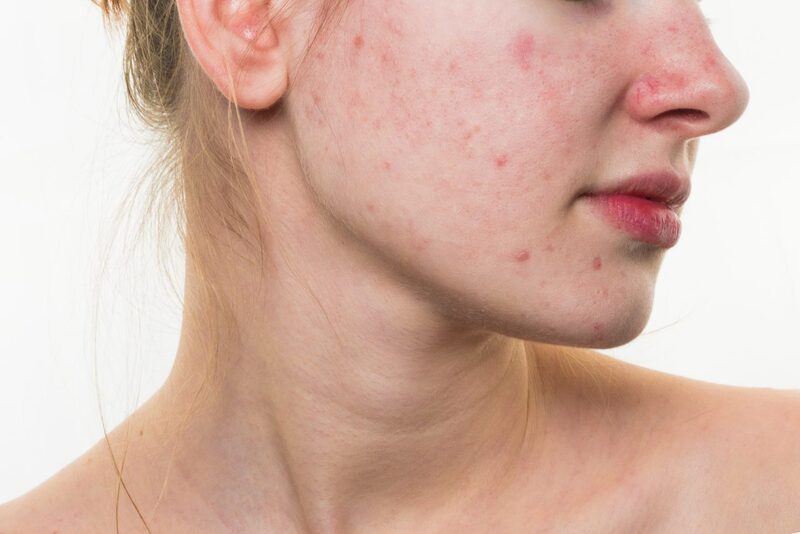 Lạm dụng chanh dưỡng da có thể gây bào mòn da