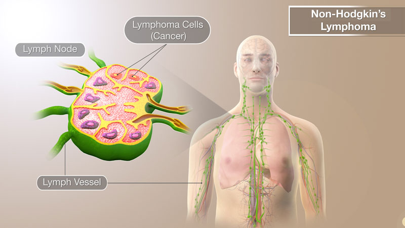 lymphoma là gì