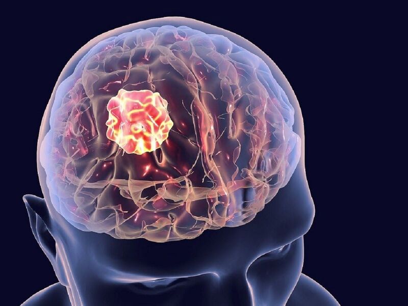 Khối u não chèn ép cũng là nguyên nhân dẫn đến xuất huyết não