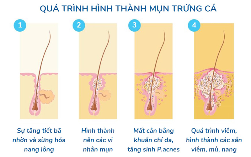 Quá trình hình thành của mụn trên bề mặt da