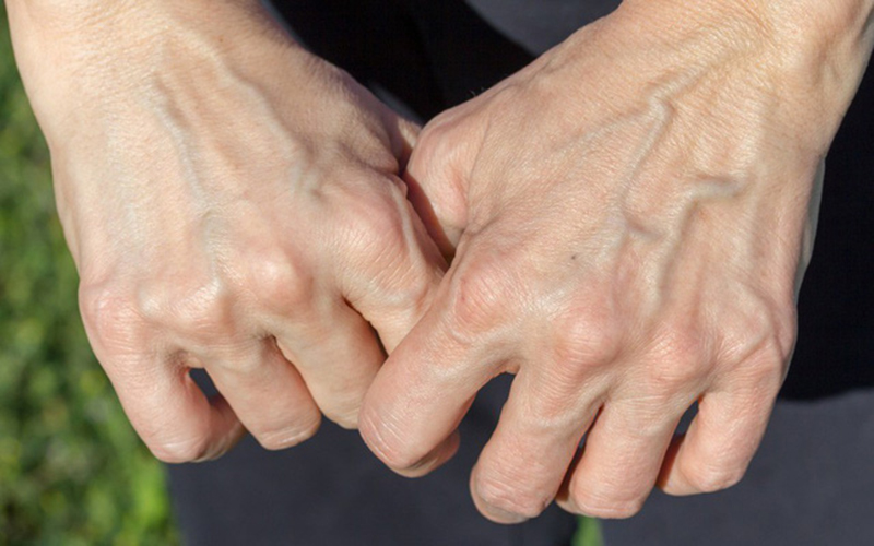 Người bị giãn tĩnh mạch tay xuất hiện những đường gân xanh nổi lên, đặc biệt là ở mu bàn tay