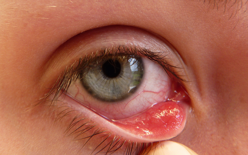 Nguyên nhân và cách chữa đau mắt hột được áp dụng phổ biến