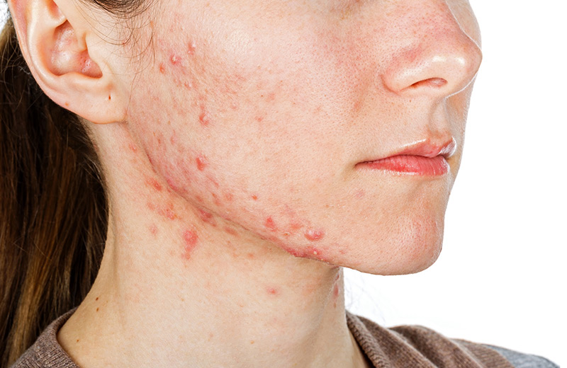 Da mặt bị dị ứng thường gây mẩn đỏ, ngứa rát khó chịu