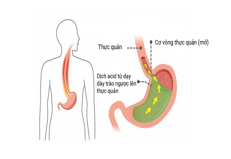 Dịch acid từ dạ dày tràn lên gây chứng ợ nóng