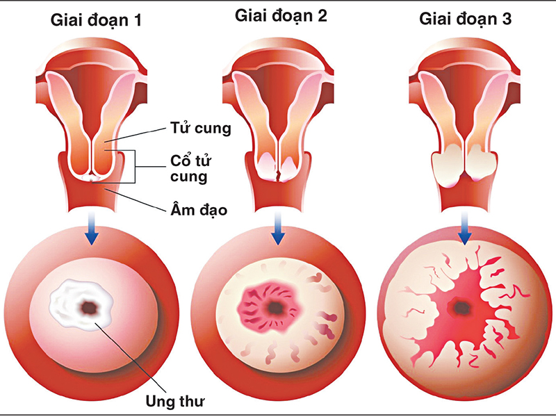 Có Nên Chích Ngừa Ung Thư Cổ Tử Cung?