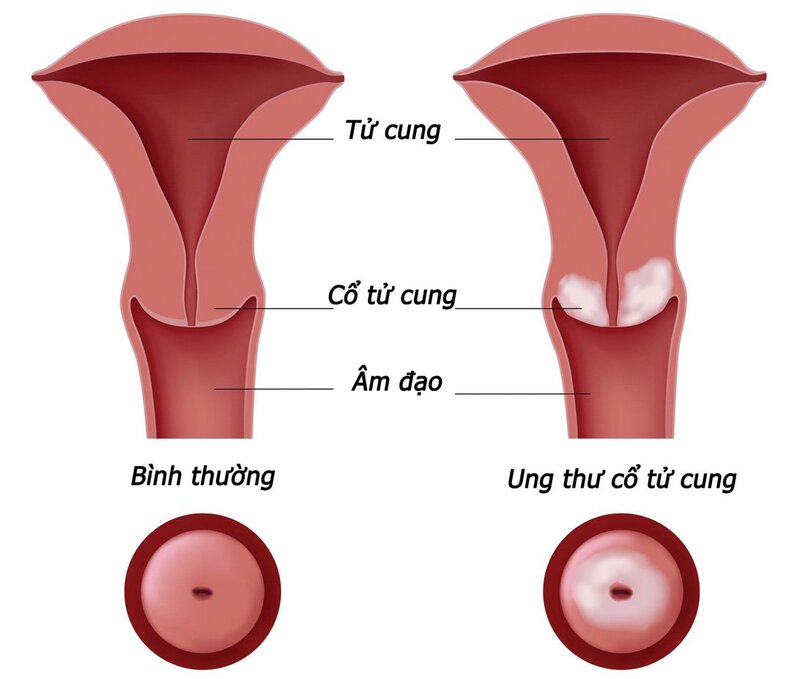 ung thư cổ tử cung giai đoạn đầu có chữa được không