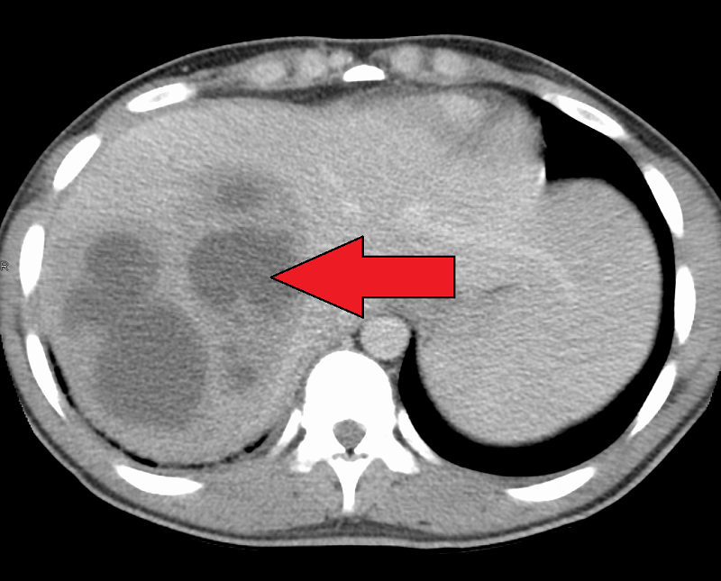 Hình ảnh cắt lớp vi tính của một ổ áp xe chứa đầy dịch mủ ở gan