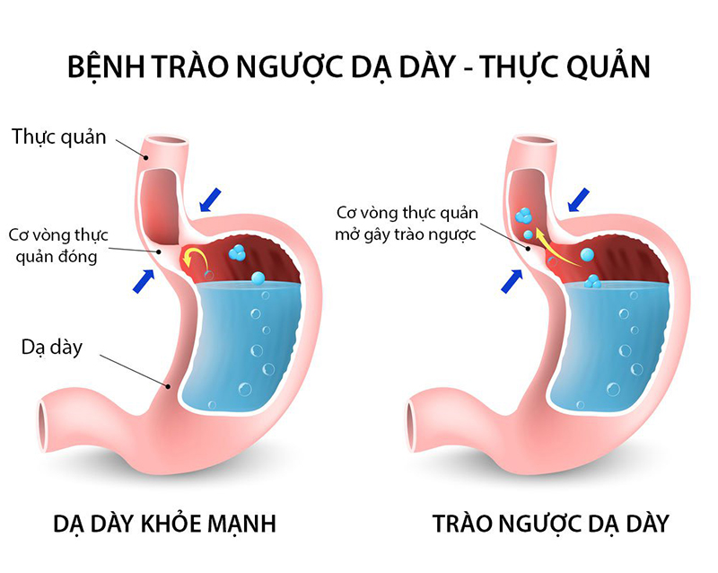 Đau Dạ Dày Gây Khó Thở: Nguyên Nhân, Cách Điều Trị Hiệu Quả