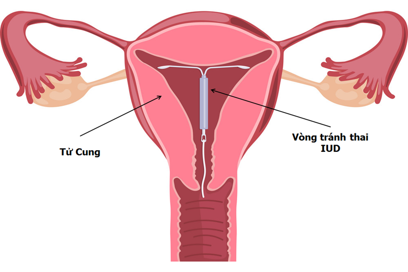 đặt vòng tránh thai có ảnh hưởng gì không 