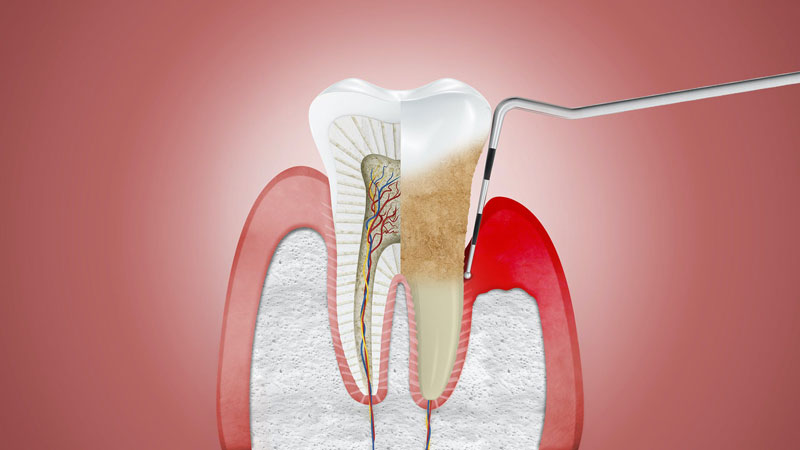 Đo độ sâu túi nha để hỗ trợ chẩn đoán bệnh