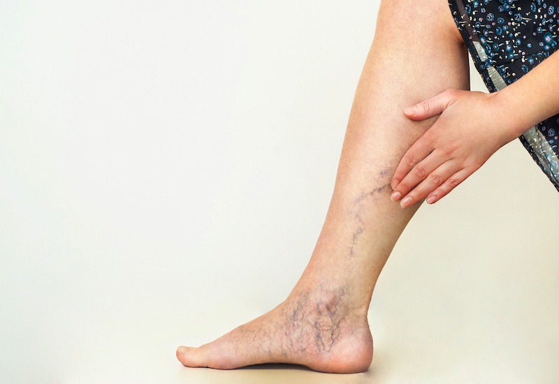 Hiểu đúng về bệnh suy giãn tĩnh mạch chân và cách điều trị hiệu quả
