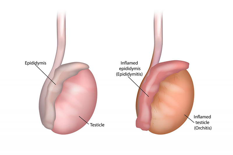 Tình trạng viêm tinh hoàn sẽ gây ảnh hưởng đến khả năng sản xuất tinh và tiết hormone sinh dục nam