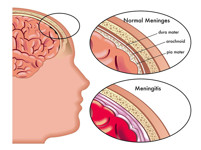 Tổng quan về viêm màng não người lớn