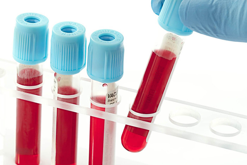 Hỏi đáp: Các chỉ số xét nghiệm sinh hóa máu nói lên điều gì?