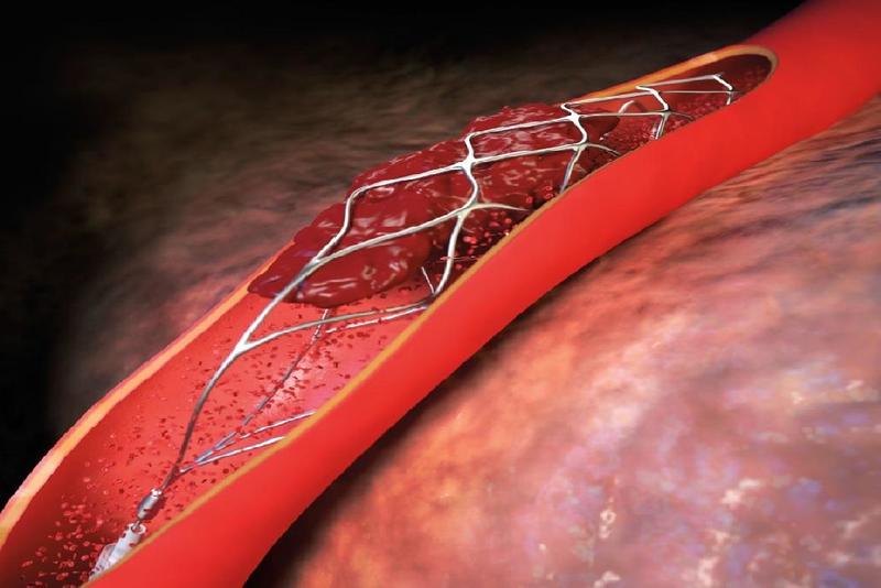 Đặt stent giúp cải thiện được hầu hết trường hợp bệnh mạch vành