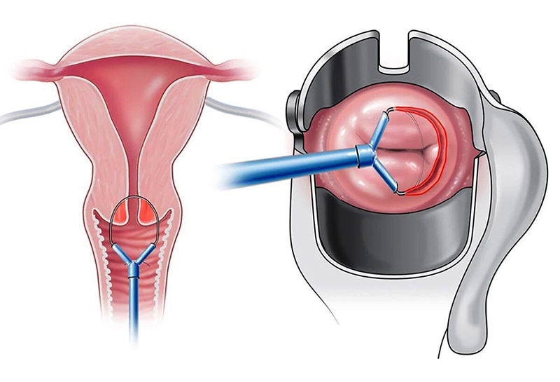 Hình ảnh mô tả kỹ thuật sinh thiết chóp cổ tử cung - một trong hai phương pháp sinh thiết cổ tử cung hiện nay
