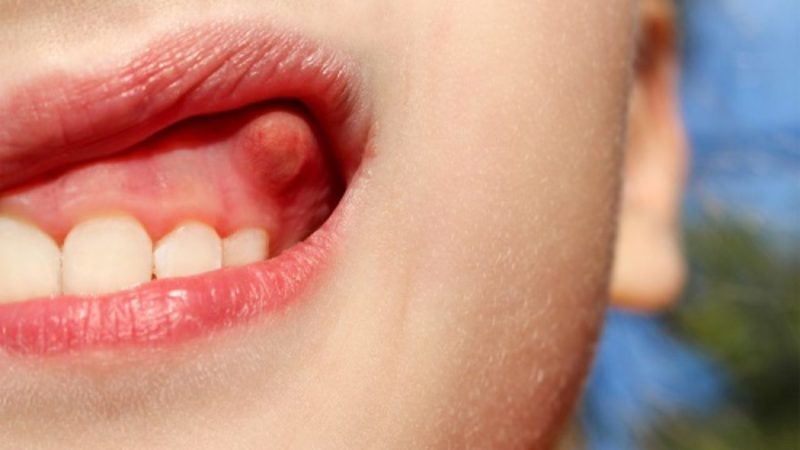 Áp xe răng là hậu quả của nhiễm trùng răng