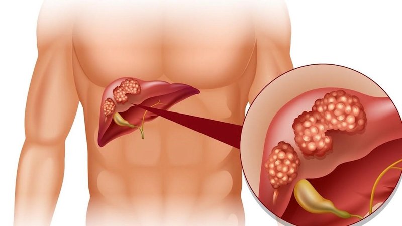 Bệnh về gan, trong đó có ung thư gan thường gây đau bụng bên phải