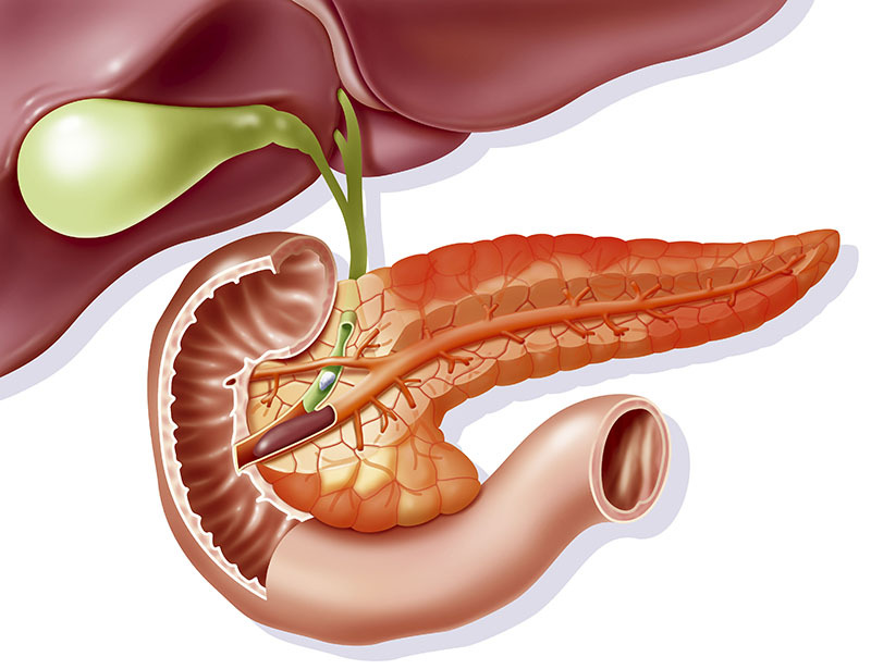 Viêm tụy thường gây đau bụng dữ dội