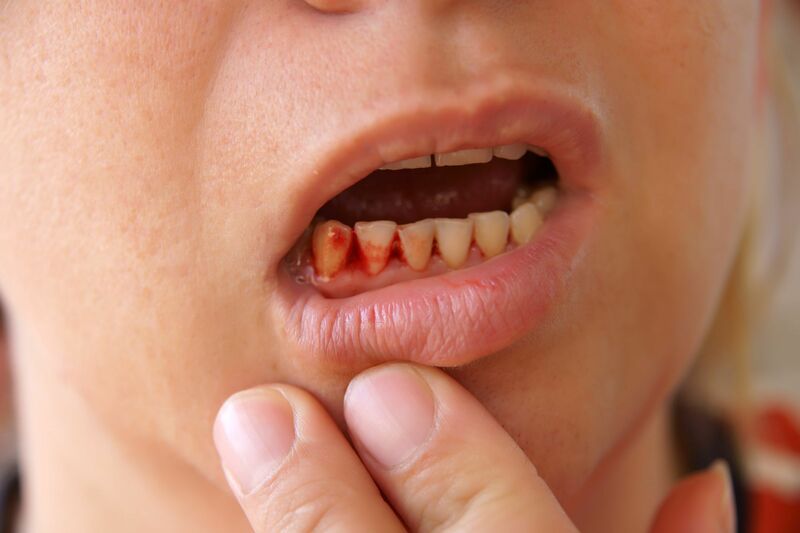 Hay bị chảy máu chân răng có nguyên nhân do đâu và cách phòng ngừa |  Medlatec