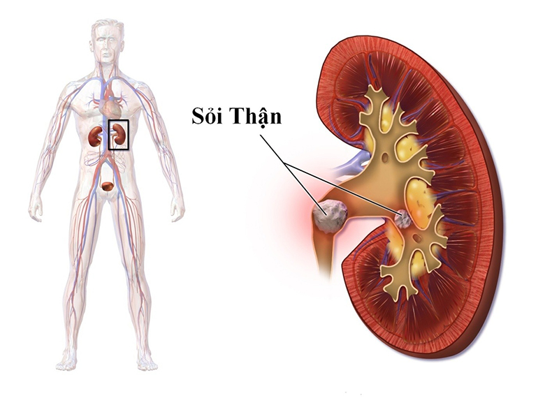 Sự hình thành sỏi ở đường tiết niệu sẽ gây tắc nghẽn và ngăn cản quá trình lưu thông của nước tiểu