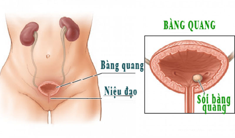 Tình trạng viêm bàng quang có thể gặp trên bệnh nhân có sỏi bàng quang