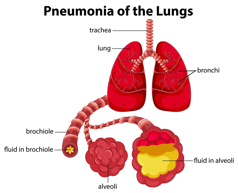 Tất tần tật những kiến thức liên quan đến bệnh viêm phổi