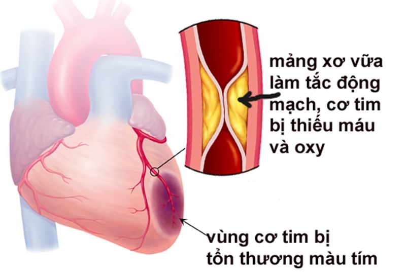 bệnh thiếu máu cơ tim có nguy hiểm không