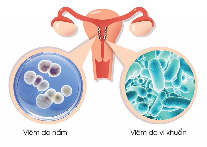 Điều trị viêm âm đạo do trùng roi